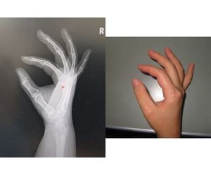 手指関節側面撮影用固定治具