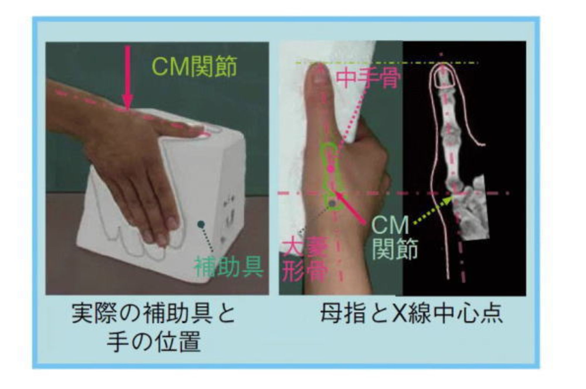 レントゲン撮影用補助具